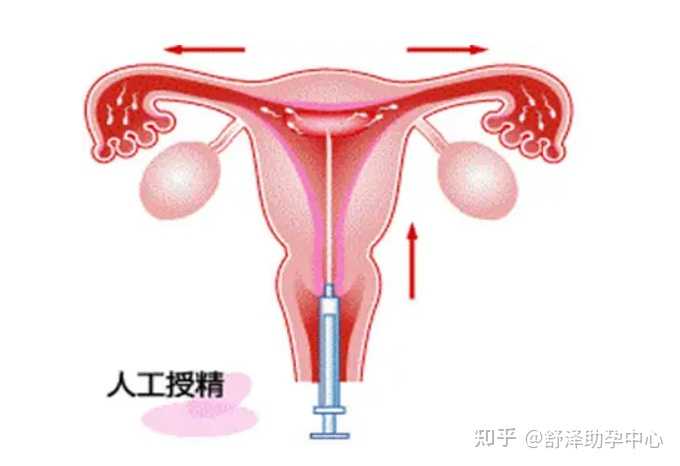 目前常见的辅助生殖技术总结_子宫性不孕